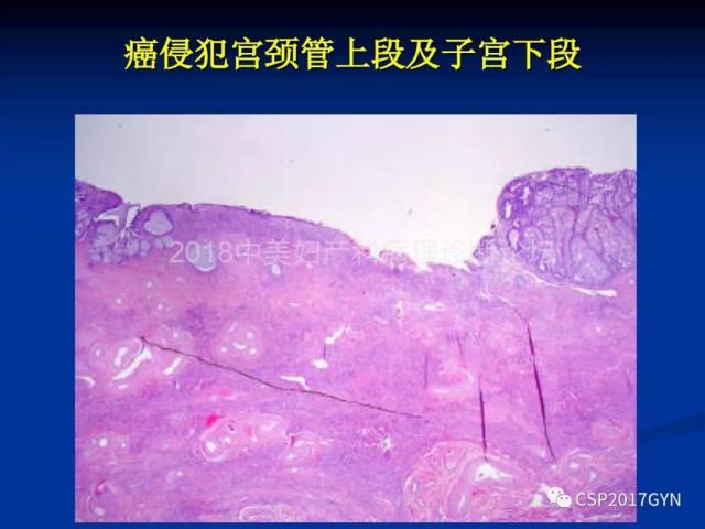 子宫内膜癌：诊断与进展