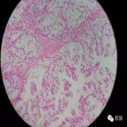 透明细胞乳头状肾细胞癌？TFE3 Traslocation Carcinoma？（赵洋分享，孔祥田(Max)*NM老师讲解）