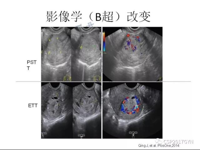 妊娠滋养细胞肿瘤的临床病理学进展