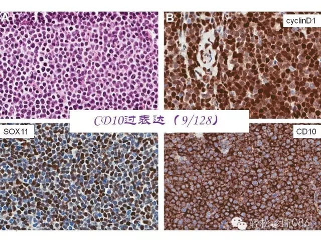 关于套细胞淋巴瘤的总结课件