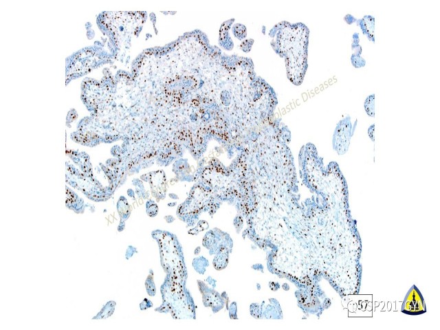 p57免疫组化染色及基因分型 在葡萄胎精确诊断中的应用