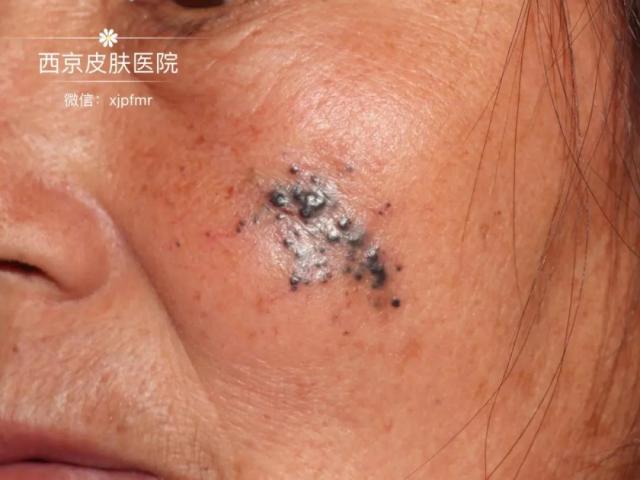 西京皮肤医院CPC病例 西京皮肤医院CPC病例