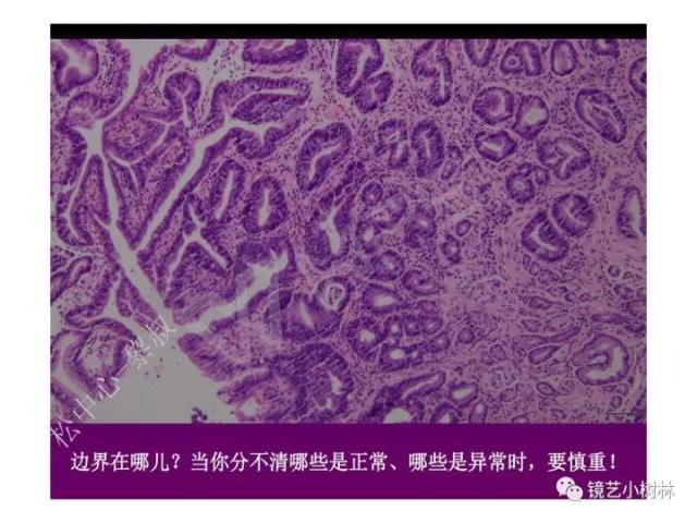 上消化道早癌病理的学习心得体会（附胃牵手癌的病例特点文献学习）