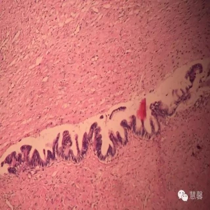 交界性黏液性囊腺瘤？癌？（魏娉分享，刘从容老师讲解）
