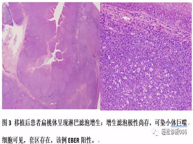 免疫缺陷相关性淋巴组织增殖性疾病（7）
