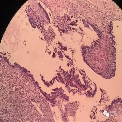 交界性黏液性囊腺瘤？癌？（魏娉分享，刘从容老师讲解）