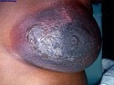 乳腺病理-炎症或反应性病变-浆细胞乳腺炎
