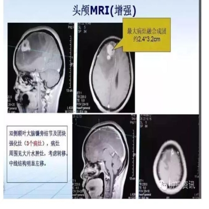 中日韩个体化诊疗案例大赛经典赏析之二——TKI治疗耐药二次活检发现SCLC转化临床病例