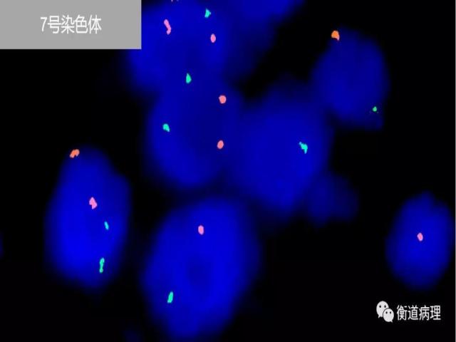 一例罕见分型肾脏肿瘤的病理解析