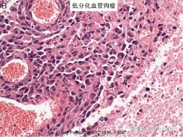 乳腺梭形细胞病变的病理诊断及进展（二）