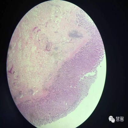 胃癌化疗后黏膜无癌、黏膜下广泛癌栓（慧馨分享，孔祥田(Max)*Roswell）