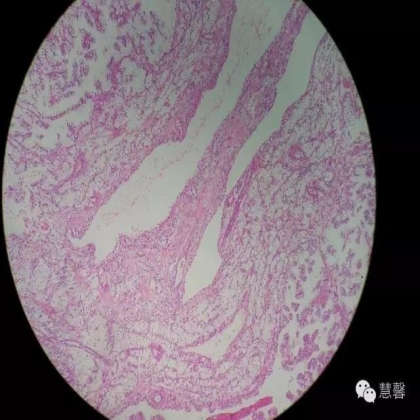 透明细胞乳头状肾细胞癌？TFE3 Traslocation Carcinoma？（赵洋分享，孔祥田(Max)*NM老师讲解）