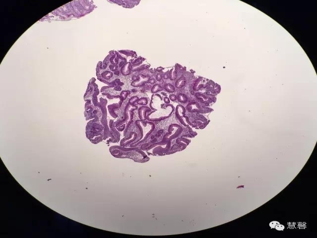 结、直肠管绒毛状腺瘤-高级别病变诊断等相关问题2（悄悄分享、孔祥田(Max)*Roswell*老师讲解）
