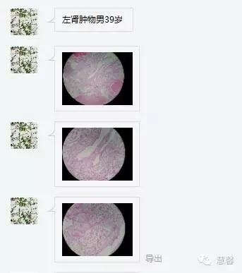 透明细胞乳头状肾细胞癌？TFE3 Traslocation Carcinoma？（赵洋分享，孔祥田(Max)*NM老师讲解）