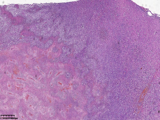 HIV相关性原发性中枢神经系统弥漫大B细胞淋巴瘤1例