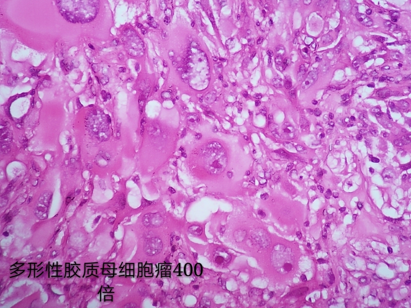 病理科工作札记（三十八）胶质母细胞瘤