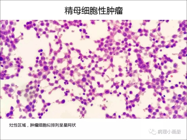 泌尿病理--精原细胞瘤VS精母细胞瘤