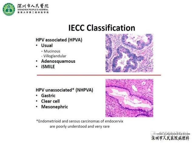 2019USCAP妇科病理热点介绍