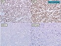 乳腺病理-乳腺癌-乳腺癌分子分型