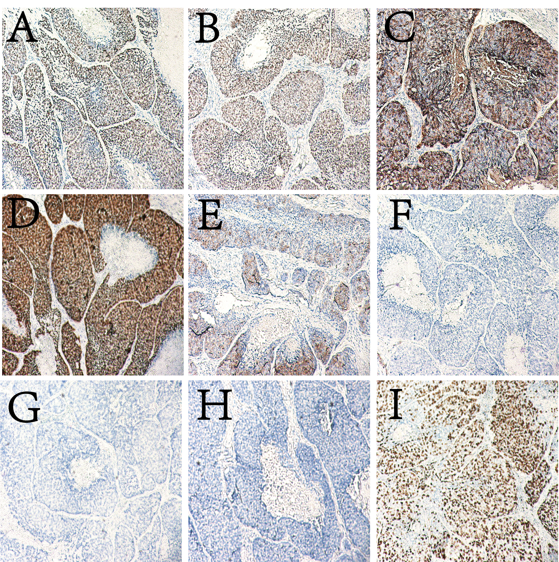 病例分享 | 食管基底样鳞状细胞癌1例