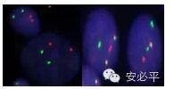 急性粒细胞白血病(AML)FISH检测
