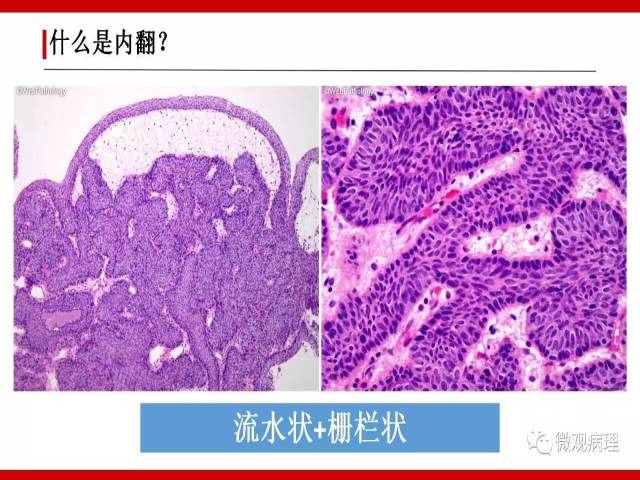 泌尿课程/尿路上皮病变的基本生长方式