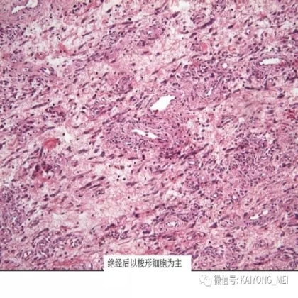 女性生殖道软组织肿瘤病理诊断及进展（二）