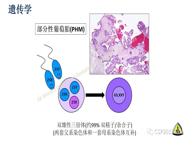 p57免疫组化染色及基因分型 在葡萄胎精确诊断中的应用