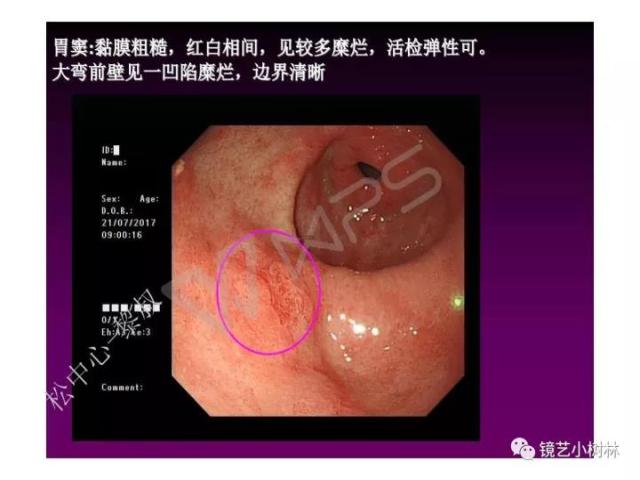 上消化道早癌病理的学习心得体会（附胃牵手癌的病例特点文献学习）