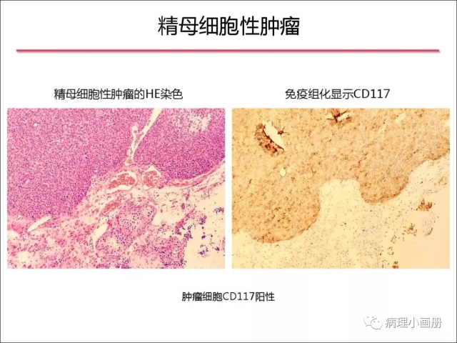 泌尿病理--精原细胞瘤VS精母细胞瘤