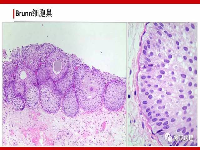 膀胱尿路上皮肿瘤诊断的一些困惑