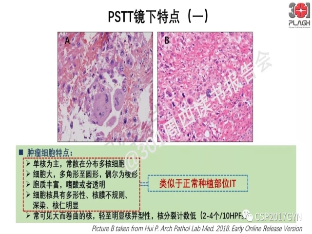 中间型滋养细胞肿瘤的诊断及鉴别诊断