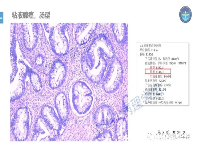 黄文亭 张询：宫颈腺癌分类介绍