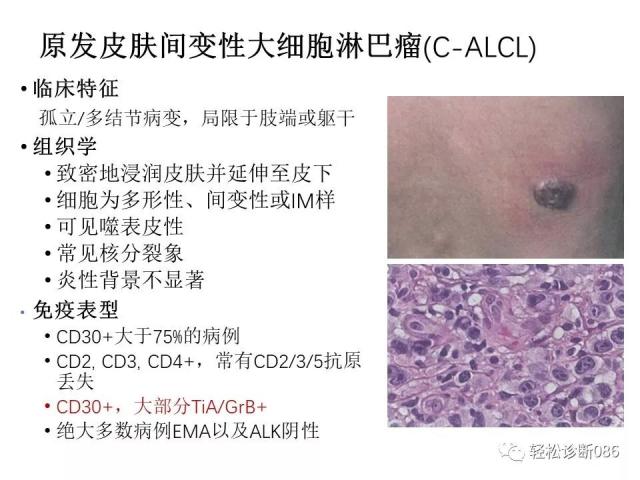 皮肤T细胞淋巴瘤