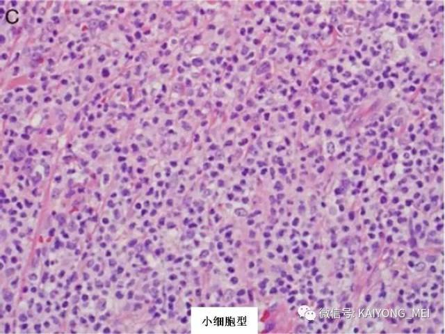 T细胞淋巴瘤病理诊断及进展（一）