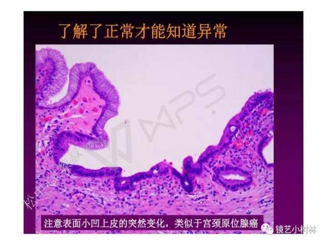 上消化道早癌病理的学习心得体会（附胃牵手癌的病例特点文献学习）