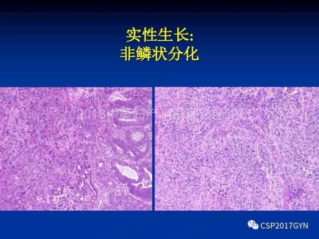 子宫内膜癌：诊断与进展