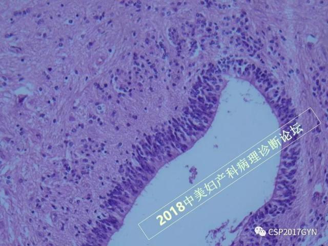 卵巢畸胎瘤诊断难点