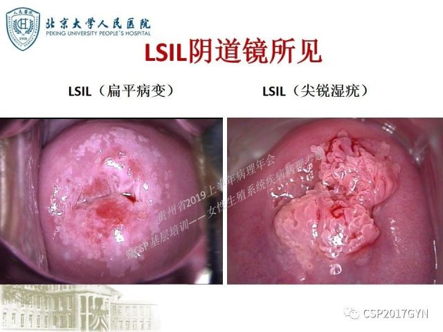 中华病理学会基层培训遵义站讲座（三）——宫颈鳞状上皮病变的病理诊断与鉴别诊断