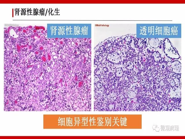 泌尿课程/尿路腺样病变的诊断要点