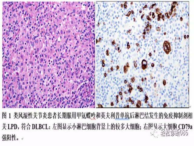 免疫缺陷相关性淋巴组织增殖性疾病（8）
