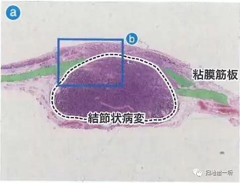 病理解读：神经内分泌癌伴扁平上皮癌