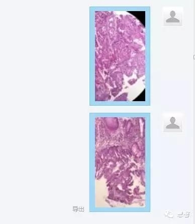 结、直肠管绒毛状腺瘤-高级别病变诊断等相关问题2（悄悄分享、孔祥田(Max)*Roswell*老师讲解）
