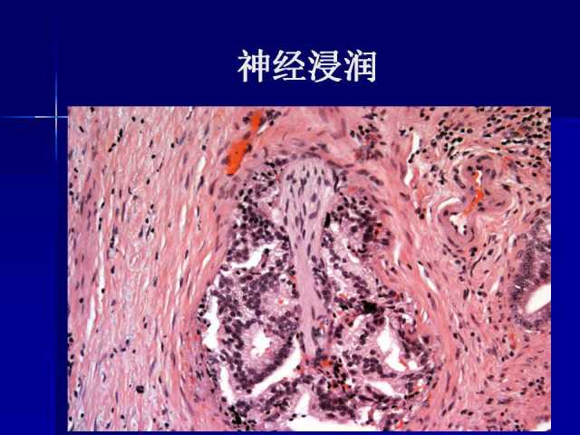 前列腺病理诊断线索（上）——黄教悌