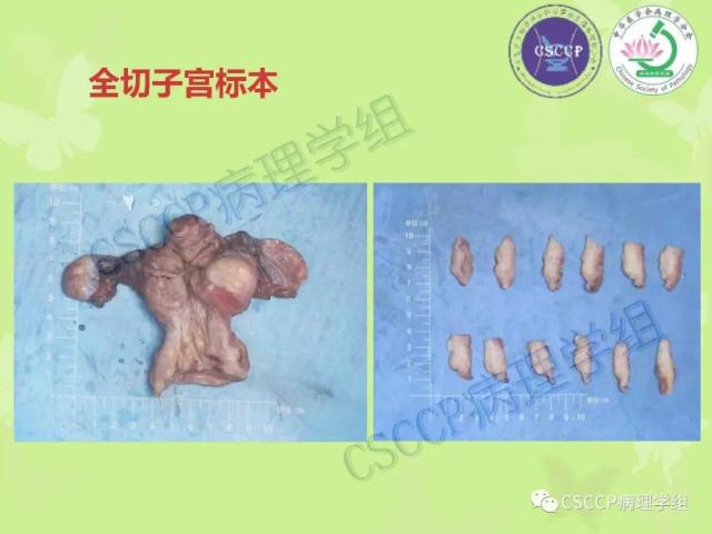 宫颈与子宫病变病理标本取材