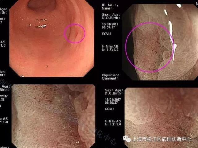 上消化道低级别上皮内瘤变的那些事