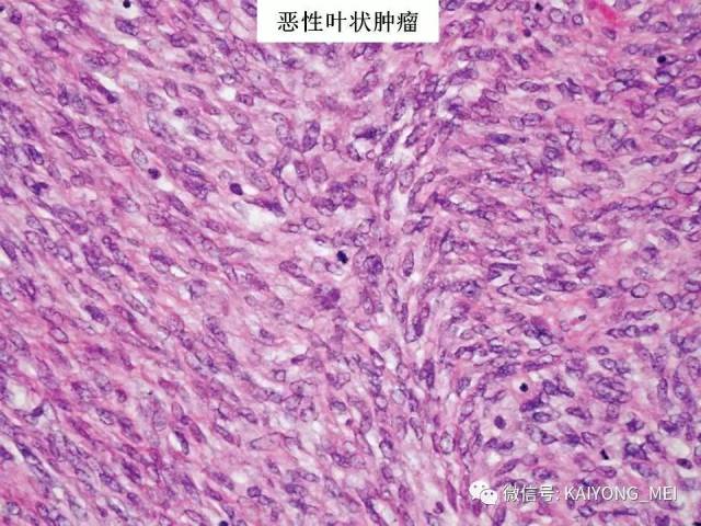 乳腺梭形细胞病变的病理诊断及进展（二）