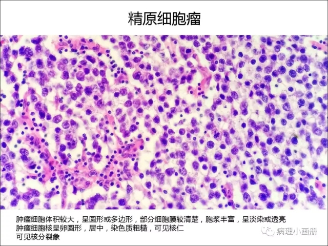 泌尿病理--精原细胞瘤VS精母细胞瘤