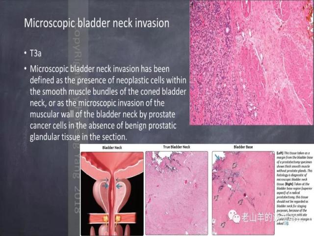 AJCC第8版 前列腺癌分期 之 病理学要点