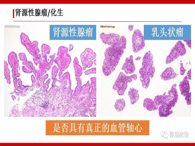 泌尿课程/尿路腺样病变的诊断要点